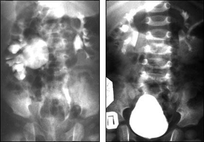 Рентгенограмма ребенка с гидронефрозом справа